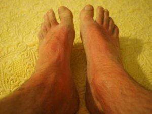 dermatitis atopica adultos