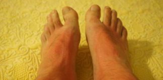 Pacientes adultos con dermatitis atópica