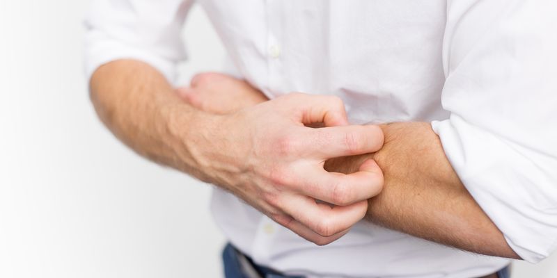 DERMATITIS-ATOPICA