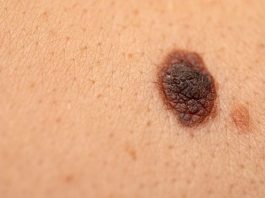 Logran reducir a la mitad el riesgo de muerte en personas con melanoma avanzado