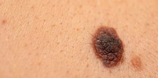 Logran reducir a la mitad el riesgo de muerte en personas con melanoma avanzado