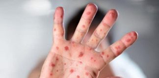 Argentina logró controlar el brote y es libre de sarampión