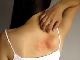 Dermatitis atópica: picazón, estrés y trastornos del sueño