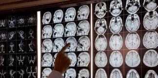 Personas con ACV llegan más tarde y con peor pronóstico a la consulta