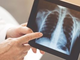 Neumonía bilateral, la enfermedad que produce más internaciones por COVID-19