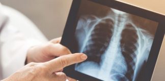 Neumonía bilateral, la enfermedad que produce más internaciones por COVID-19