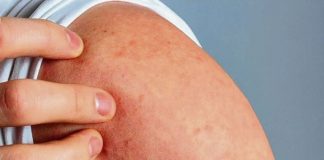 Dermatitis atópica: aprueban en Argentina la indicación en adolescentes de un medicamento