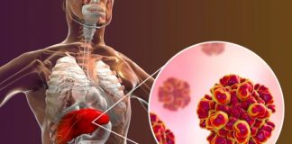 Nueva gu铆a y estrategias para facilitar el acceso al diagn贸stico de hepatitis B y C