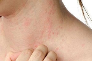 Dermatitis atopica 1