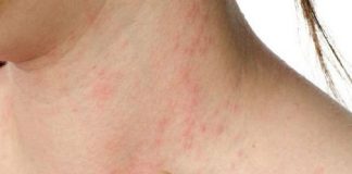 Dermatitis atópica: una encuesta asegura que empeoró la calidad de vida de los pacientes