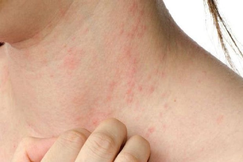 Dermatitis atopica 1