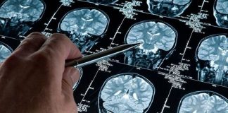 Alzheimer: un software argentino podría diagnosticarlo de forma precoz