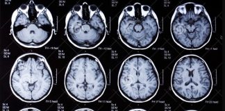 Covid-19: expertos de Oxford detectaron que puede provocar cambios en el cerebro