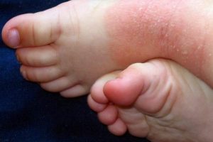 dermatitis en niños