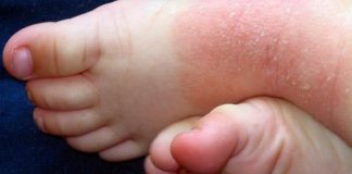 Dermatitis atópica severa: aprueban el uso en niños de un tratamiento innovador para la