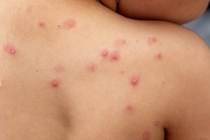 viruela mono -