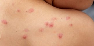 Confirman el cuarto caso de viruela símica en Argentina