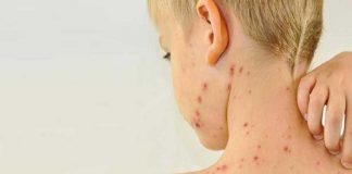 Sarampión: confirman un caso en Argentina