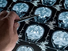 Alzheimer: ahora puede ser detectado 20 años antes de la aparición de síntomas