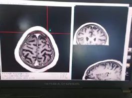 San Isidro: exitosa cirugía de Parkinson para mejorar síntomas de la enfermedad