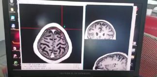 San Isidro: exitosa cirugía de Parkinson para mejorar síntomas de la enfermedad