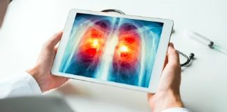 Cáncer de pulmón: cómo es el estudio argentino para mejorar el diagnóstico temprano