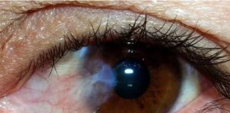 Salud visual: charla abierta a la comunidad para detectar cataratas