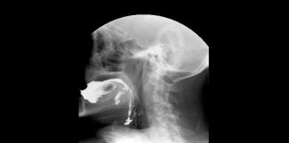 Tigre: nuevo estudio de videodeglución en el Hospital Materno Infantil