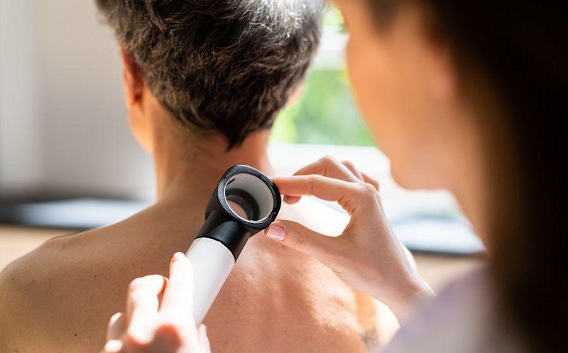 melanoma