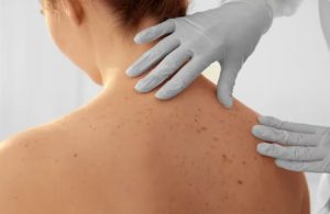 MELANOMA