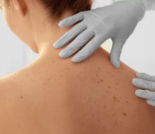 Día Mundial del Melanoma: protegerse del sol reduce en un 70% el riesgo de cáncer de piel