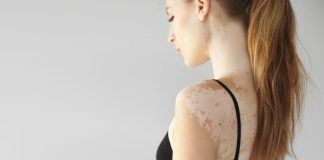 Día Mundial del Vitiligo: claves para reconocerlo