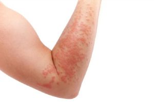 psoriasis