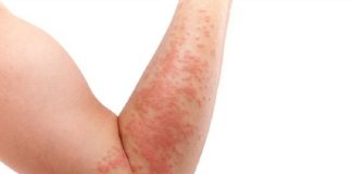 Psoriasis: una encuesta asegura que el 42% de los pacientes postergó o suspendió la consulta médica por motivos económicos