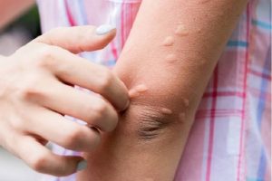 urticaria 2
