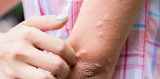Urticaria crónica: más allá de la picazón, un impacto profundo en la calidad de vida
