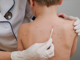 Sarampión: con 32 casos confirmados en todo el país adviertan la importancia de vacunarse