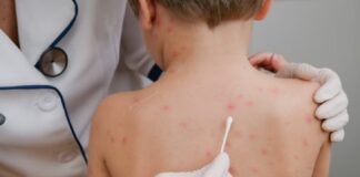 Sarampión: con 32 casos confirmados en todo el país adviertan la importancia de vacunarse