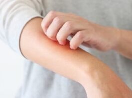 Dermatitis atópica: campaña gratuita de detección de esta enfermedad de la piel en todo el país