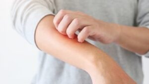 dermatitis atopica - foto 1