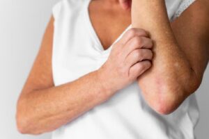 psoriasis