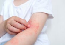 Dermatitis atópica: la demora en autorizar la medicación es uno de los principales obstáculos para tratar esta enfermedad