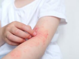 Dermatitis atópica: la demora en autorizar la medicación es uno de los principales obstáculos para tratar esta enfermedad