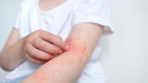 dermatitis atopica