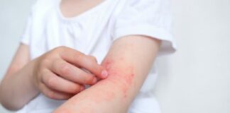 Dermatitis atópica: la demora en autorizar la medicación es uno de los principales obstáculos para tratar esta enfermedad