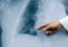 Cáncer de pulmón: «El tratamiento no depende solo de los avances médicos, sino también del apoyo emocional»