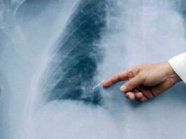 Cáncer de pulmón: «El tratamiento no depende solo de los avances médicos, sino también del apoyo emocional»