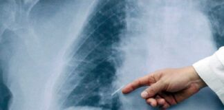 Cáncer de pulmón: «El tratamiento no depende solo de los avances médicos, sino también del apoyo emocional»