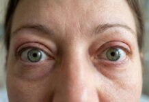 Enfermedad ocular tiroidea: síntomas y cómo evitar la odisea de llegar al diagnóstico