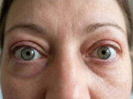 Enfermedad ocular tiroidea: síntomas y cómo evitar la odisea de llegar al diagnóstico